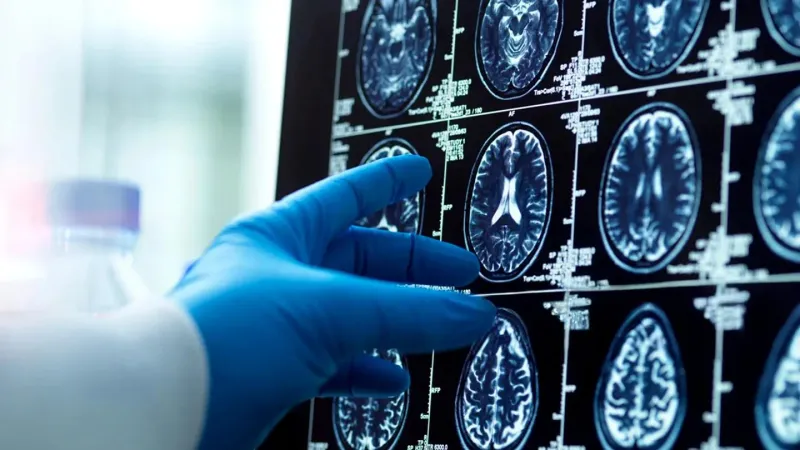 الرجال يفقدون بنية الدماغ أسرع من النساء.. دراسة تكشف مفاجآت جديدة عن شيخوخة الدماغ والزهايمر