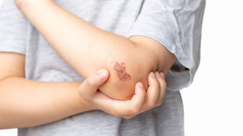 لماذا ترفض بعض الجروح الالتئام؟ علماء يكتشفون سببًا غير متوقع