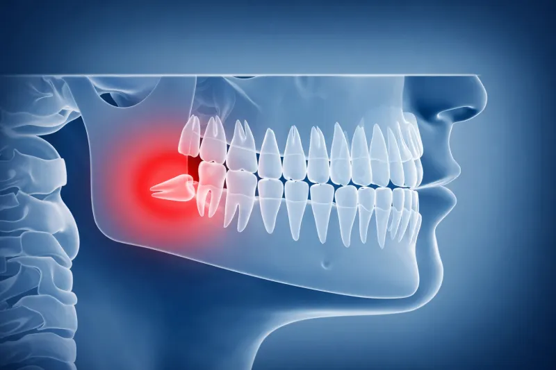 لماذا يمتلك الإنسان ضروس العقل؟ العلم يوضح السبب التطوري