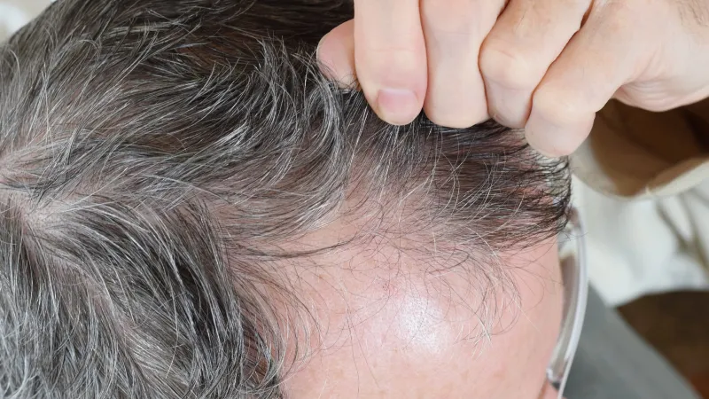 علماء يبتكرون مصلاً نباتيًا قد يعيد إنبات الشعر خلال أسابيع