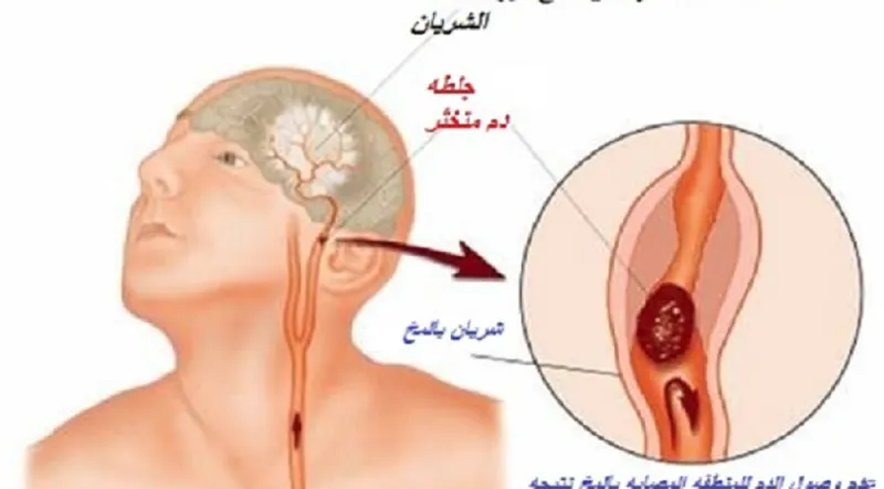 دراسة: العمى المؤقت ينذر بسكتة دماغية!