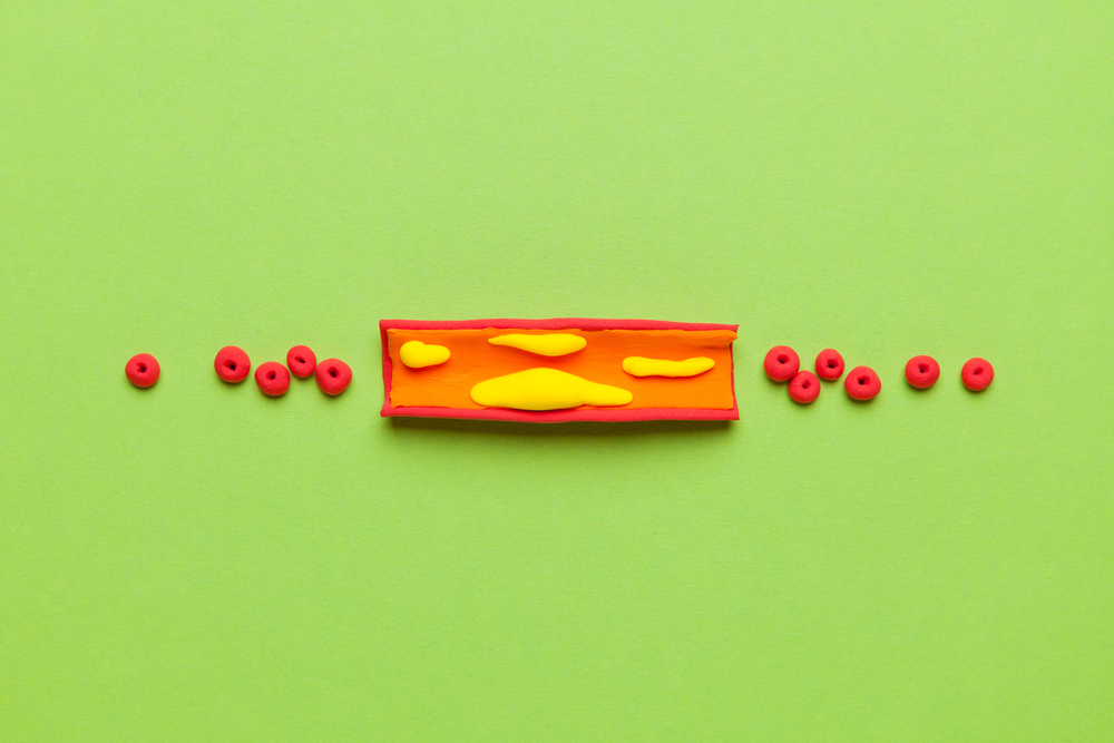 مُجسّم لشريان به ترسّبات "لويحات" تعبيرية عن علاقة Lp (a) بارتفاع الكوليسترول وأمراض الشرايين