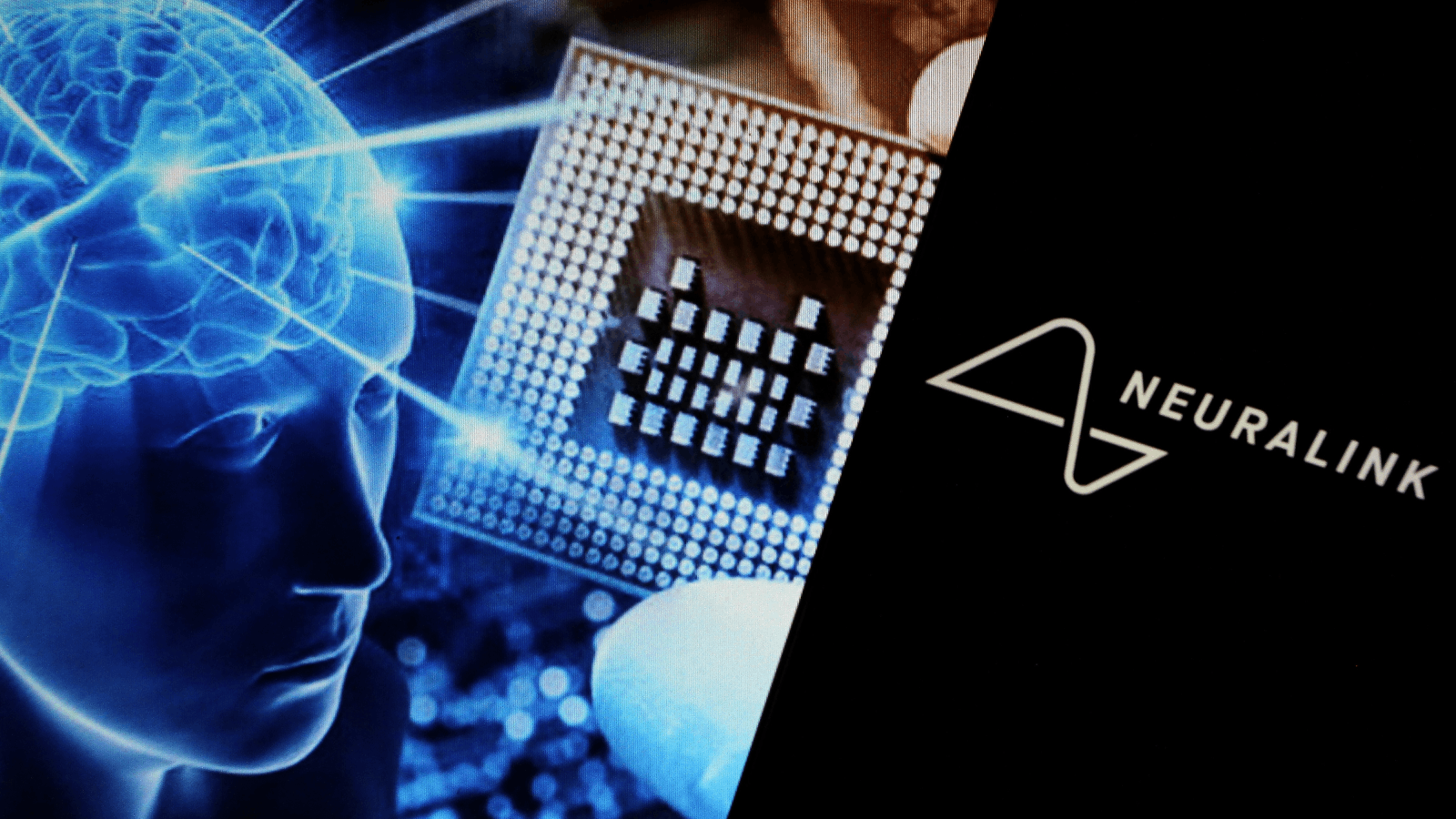 إيلون ماسك يحقق إنجازًا طبيًا بزرع أول شريحة دماغية لاسلكية