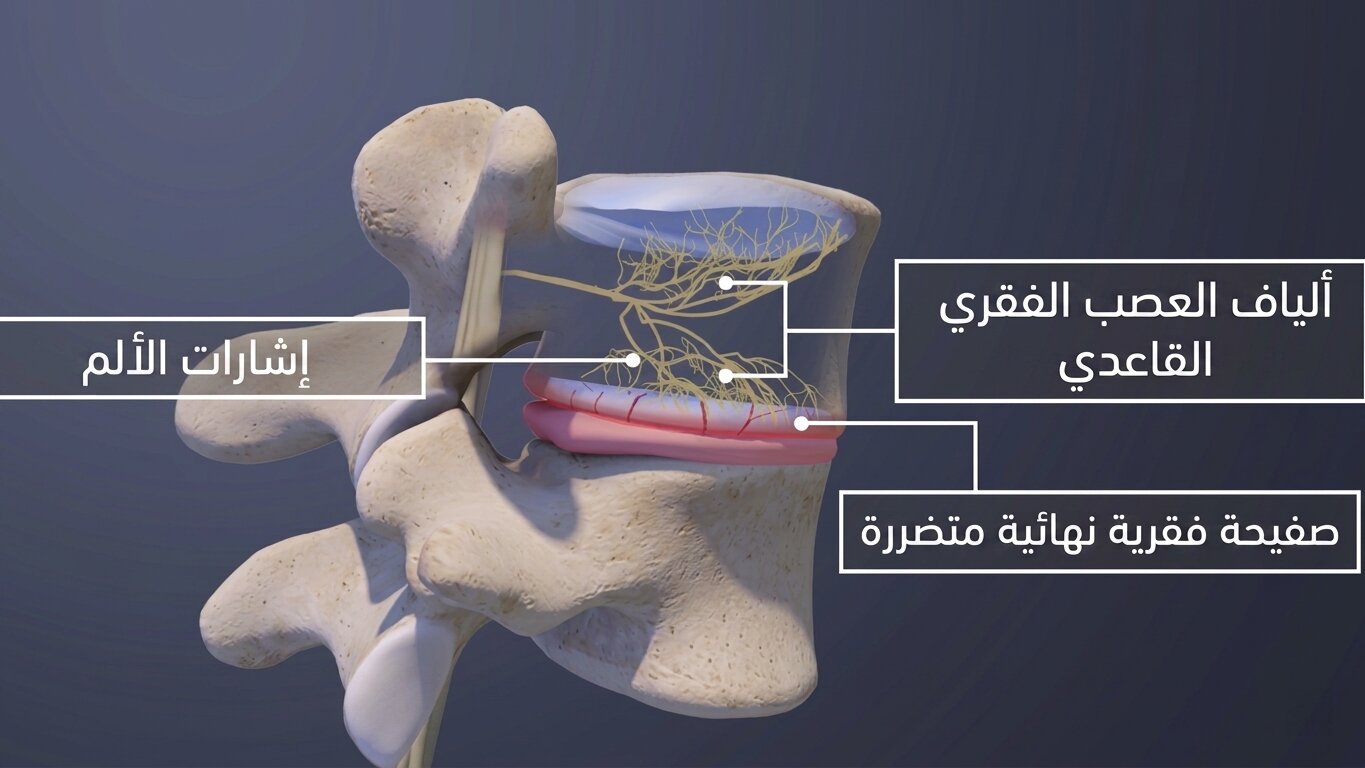 العلاقة بين تضرر الصفيحة الفقرية النهائية وآلام الأعصاب