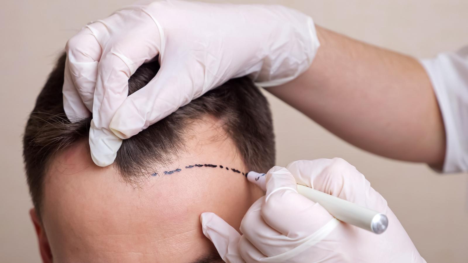 زراعة الشعر أحد طرق علاج تساقط الشعر بدلًا من فيناسترايد